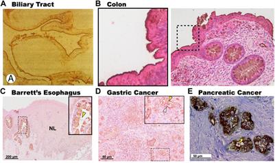 3′-sulfated LewisA/C: An oncofetal epitope associated with metaplastic and oncogenic plasticity of the gastrointestinal foregut